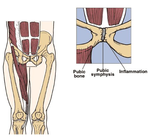 Groin Pain During Sport - What is going on? - Flexed